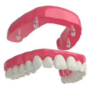 modelo-sobredentadura-2 Sobredentadura o Prótesis sobre 4 implantes