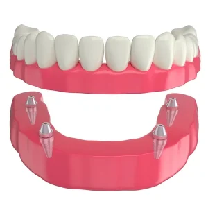modelo-sobredentadura Sobredentadura para fijarse a 4 implantes