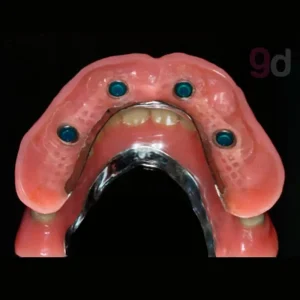 modelo-sobredentarua-goaldental Modelo de sobredentadura para 4 implantes