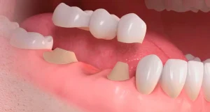 Puente dental sobre dientes naturales