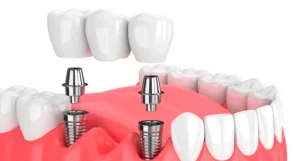 Puentes dentales sobre implantes dentales