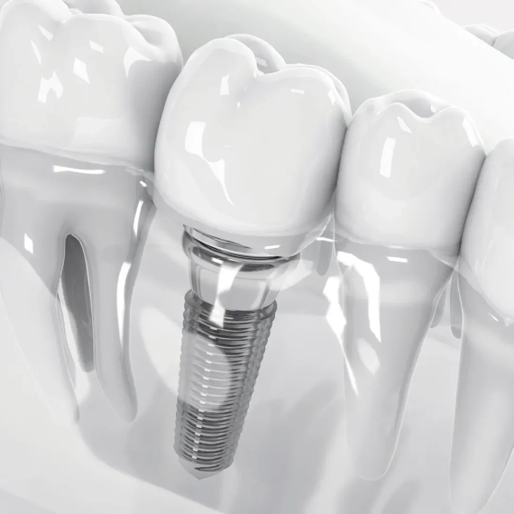 implante-dental Implante dental