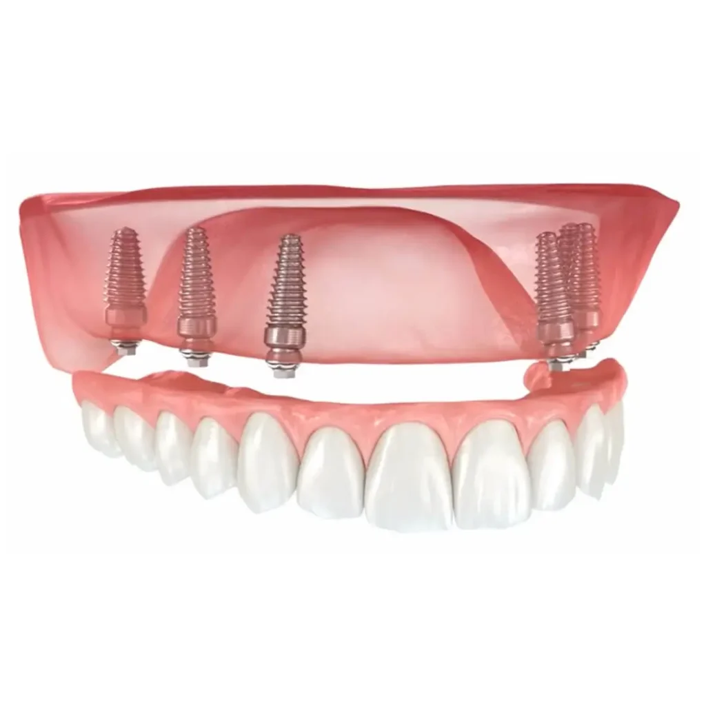 protesis-dental Prótesis Dental