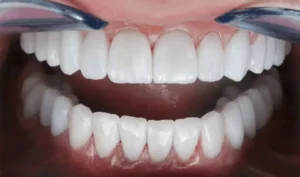 12 implantes con 24 fundas