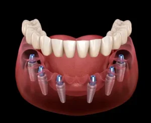 6 implantes dentales con 12 coronas